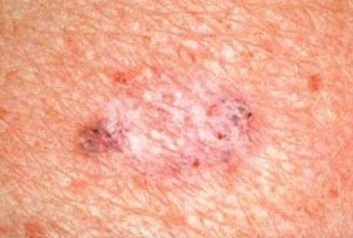 late signs of Melanoma