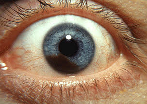 ocular cancer in the iris